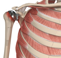 Revision Shoulder Replacement