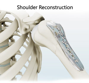 Shoulder Reconstruction