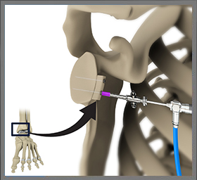 Arthroscopic Distal Tibia Allograft
