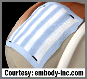 Embody Tapestry Bovine Collagen Graft