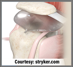 Stryker InSpace Subacromial Balloon Spacer