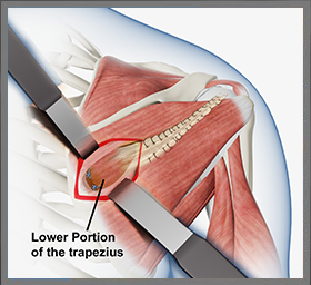 Lower Trapezius Transfer