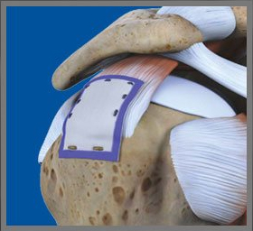 Regeneten Medical Rotator Cuff System