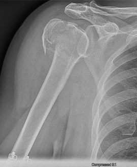 Reverse Shoulder Replacement for Proximal Humerus Fracture