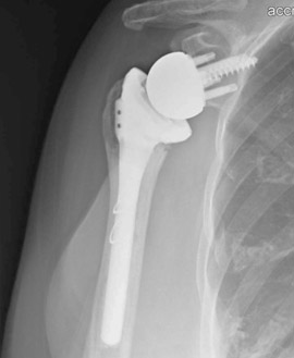 Reverse Shoulder Replacement for Proximal Humerus Fracture