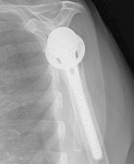 Reverse Shoulder Replacement for Proximal Humerus Fracture