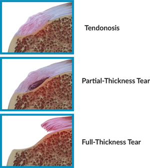 Why Did My Rotator Cuff Tear?