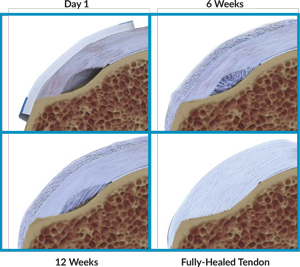 The Rota on Medical Rotator Cuff System