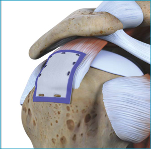 The Rota on Medical Rotator Cuff System