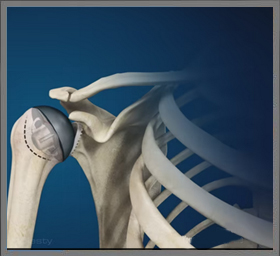 Stemless Total Shoulder Replacement